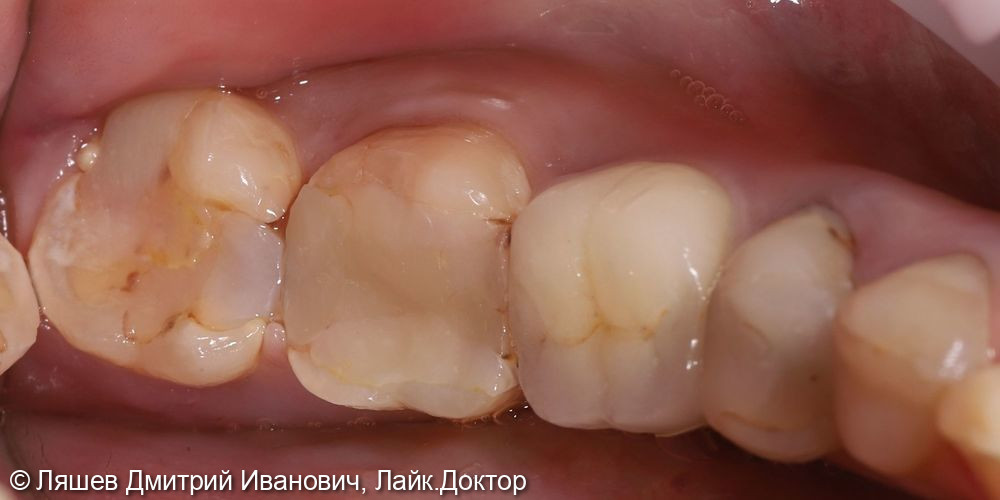 Лечение кариеса зубов 3.7,3.8 - фото №1