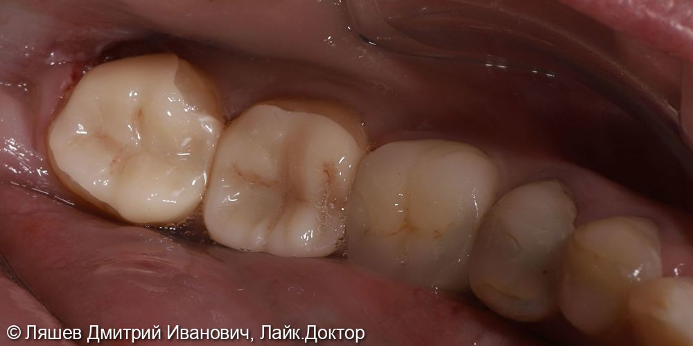 Лечение кариеса зубов 3.7,3.8 - фото №2
