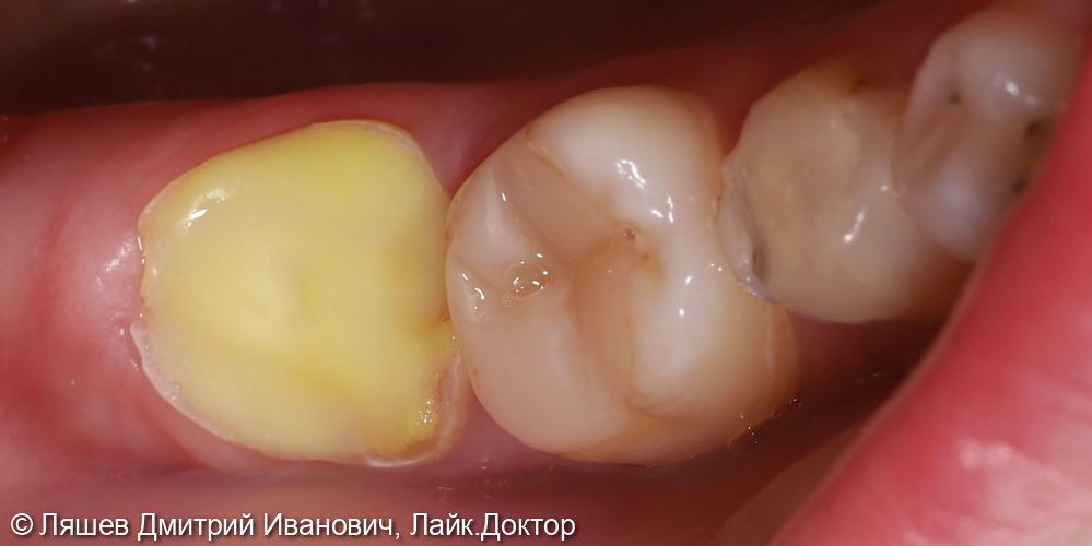 Лечение кариеса зуба 4.7 - фото №1