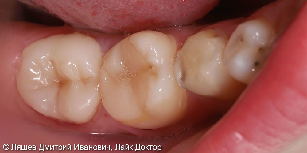 Лечение кариеса зуба 4.7 - фото №2