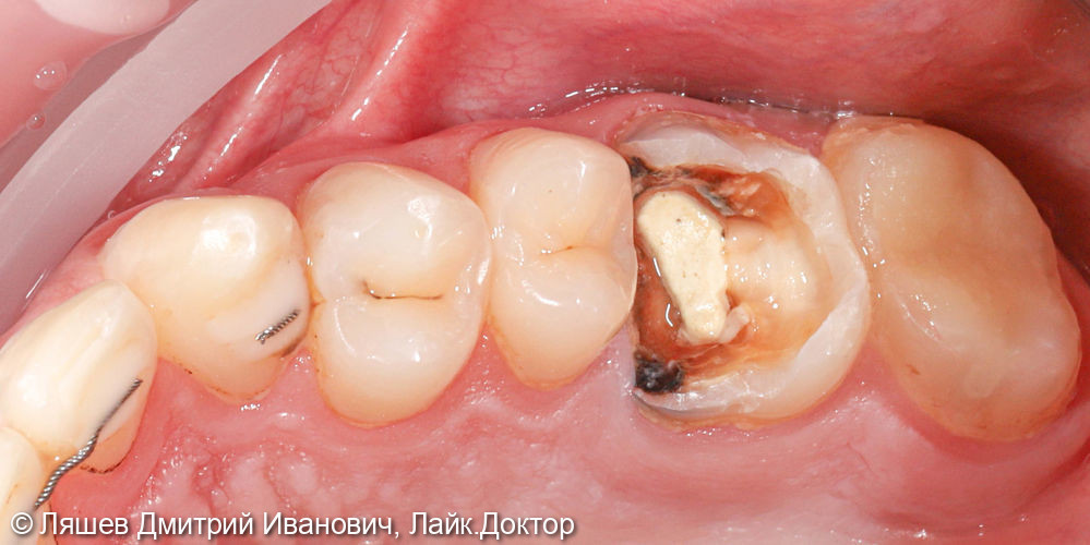 Лечение зуба 2.6 - фото №1