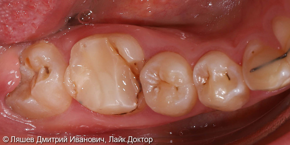 Лечение кариеса зуба 4.6 - фото №1