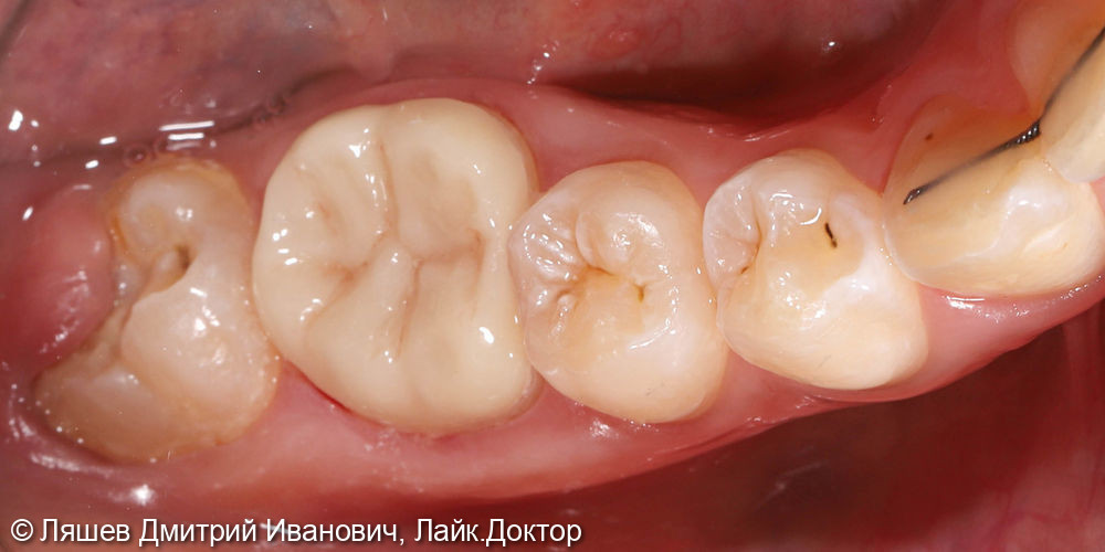Лечение кариеса зуба 4.6 - фото №2