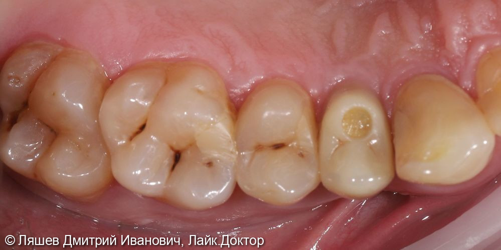 Лечение кариеса зуба 2.6 - фото №1