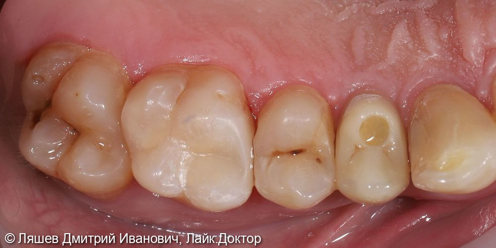 Лечение кариеса зуба 2.6 - фото №2