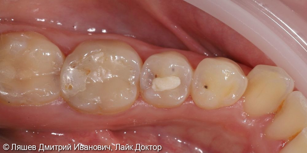Лечение кариеса зуба 3.5 - фото №1