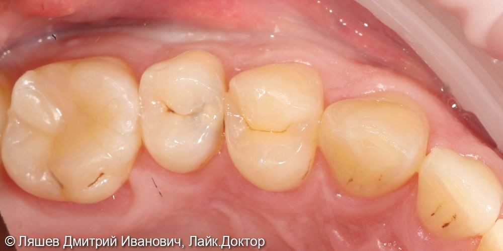 Лечение кариеса зуба 1.5 - фото №1