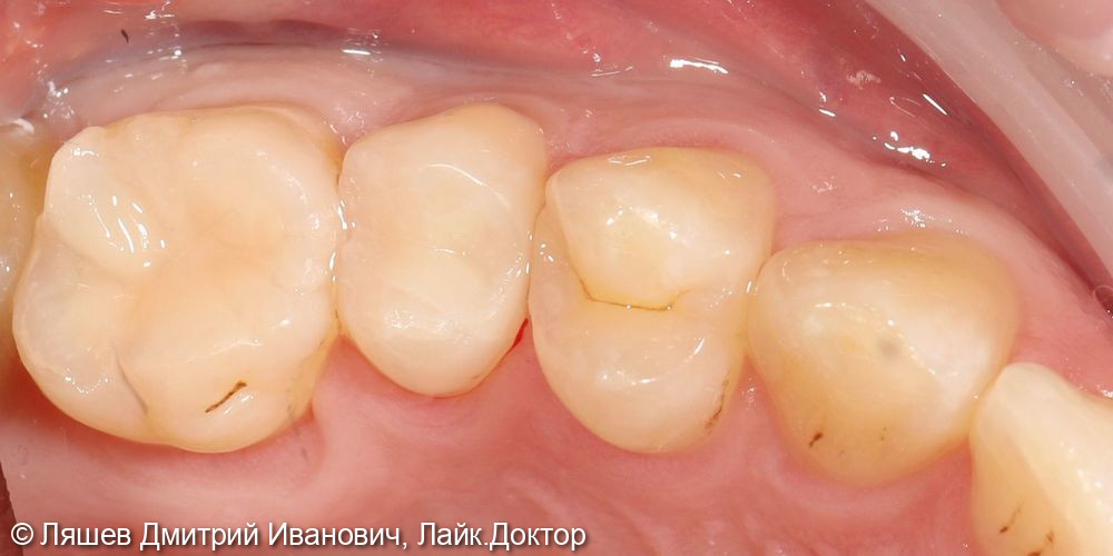 Лечение кариеса зуба 1.5 - фото №2