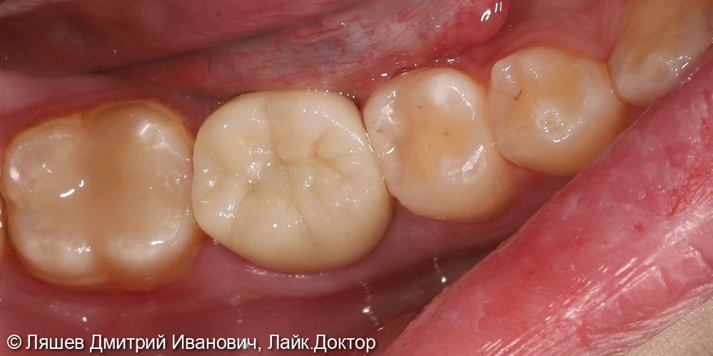 Лечение зуба 4.6 - фото №2