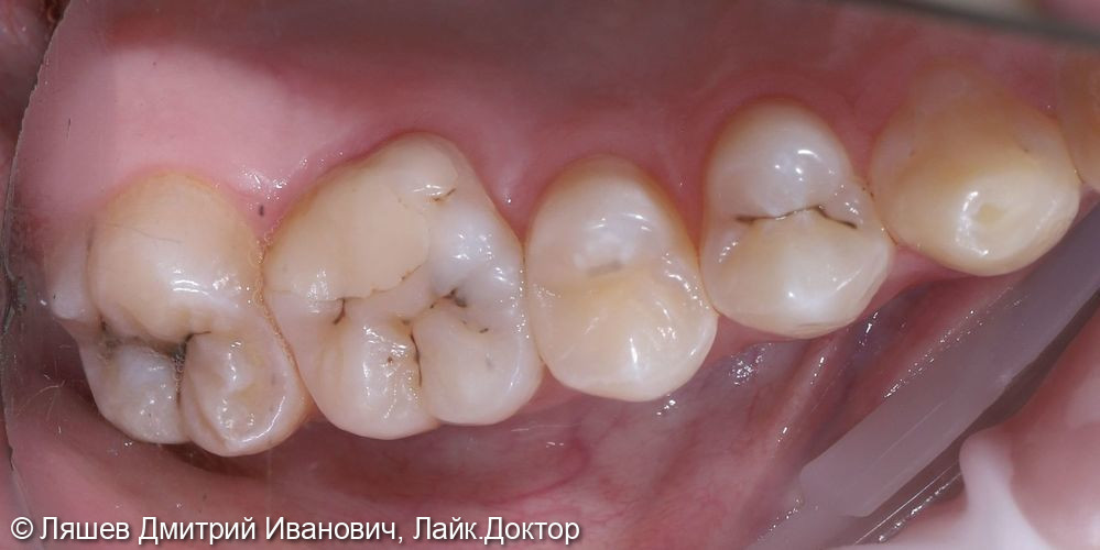 Лечение кариса зуба 2.6,2.7 - фото №1