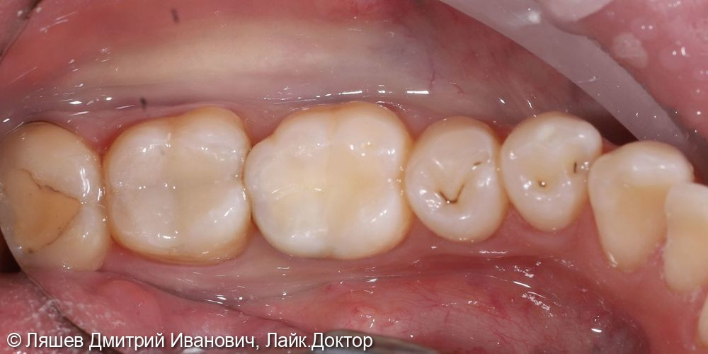 Лечение кариеса зуба 3.6,3.7 - фото №2