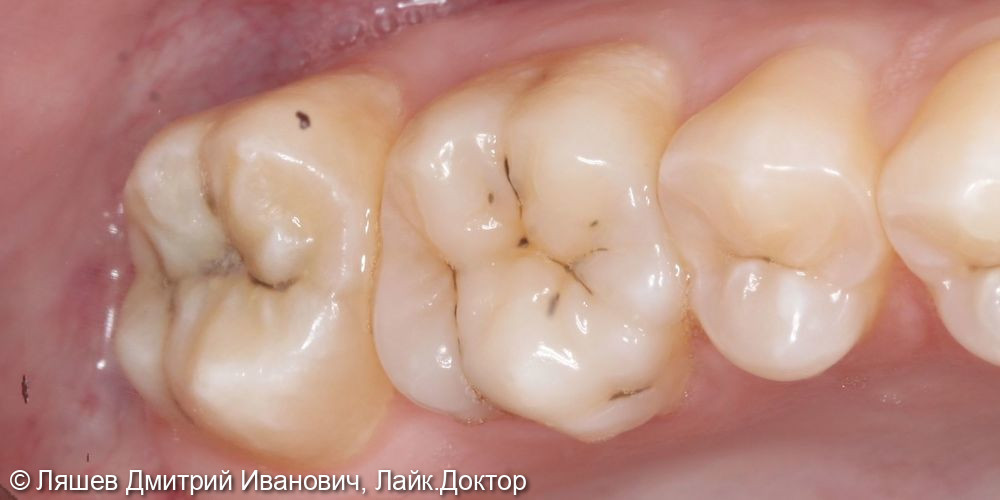 Лечение кариеса дентина зуба 1.7 - фото №1