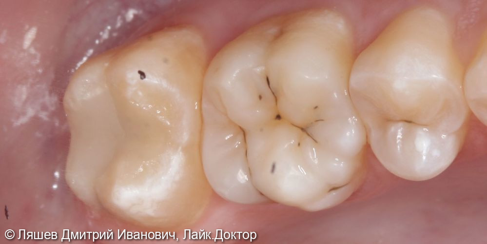 Лечение кариеса дентина зуба 1.7 - фото №2