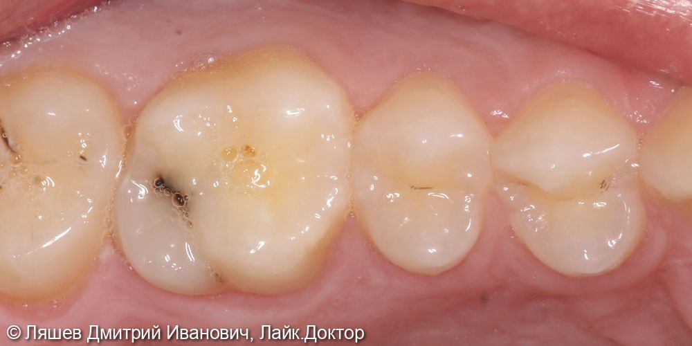Лечение кариеса дентина зуба 1.6 - фото №1