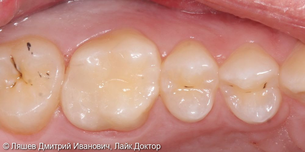 Лечение кариеса дентина зуба 1.6 - фото №2