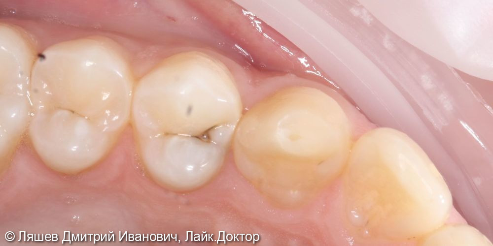 Лечение кариеса дентина зуба 1.4 - фото №1