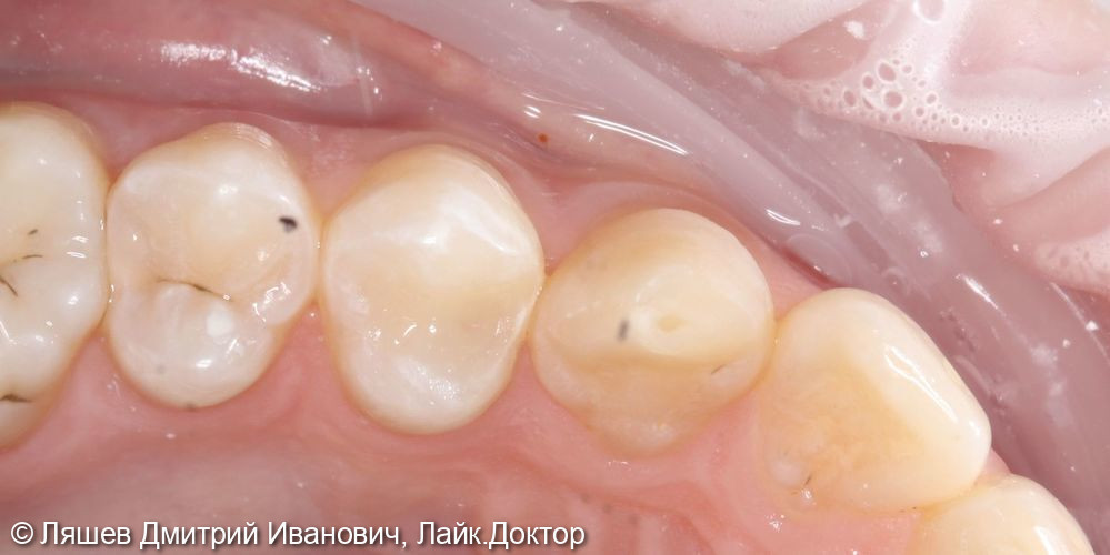 Лечение кариеса дентина зуба 1.4 - фото №2