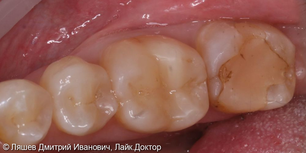 Лечение кариеса дентина зуба 4.7 - фото №1