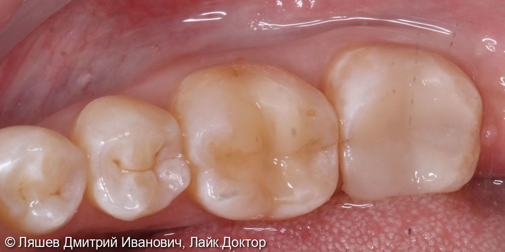 Лечение кариеса дентина зуба 4.7 - фото №2