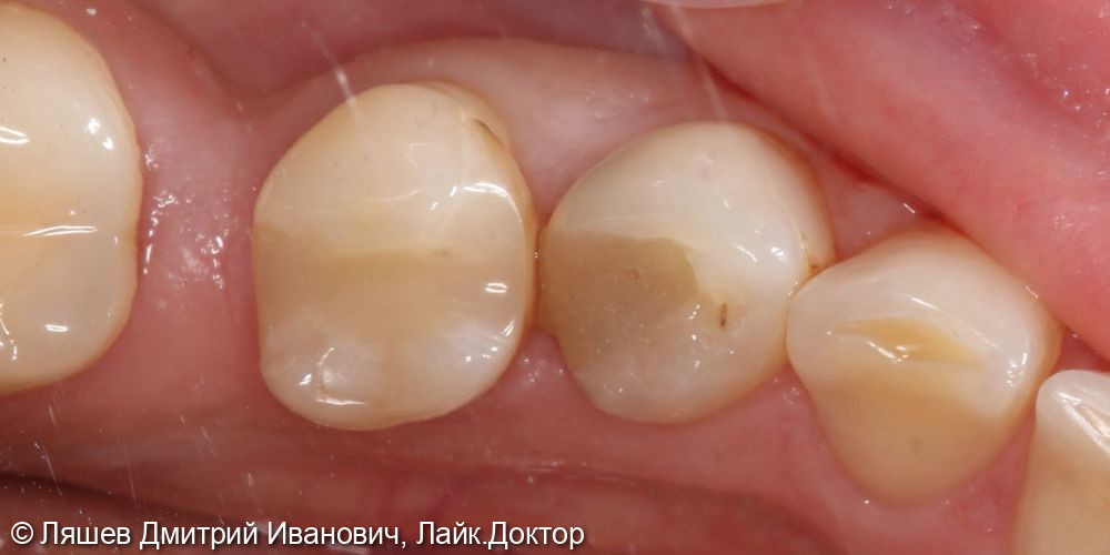 Лечение кариеса дентина зуба 4.4 - фото №1