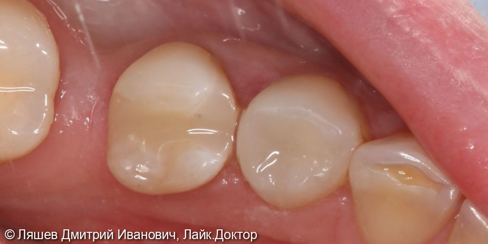 Лечение кариеса дентина зуба 4.4 - фото №2