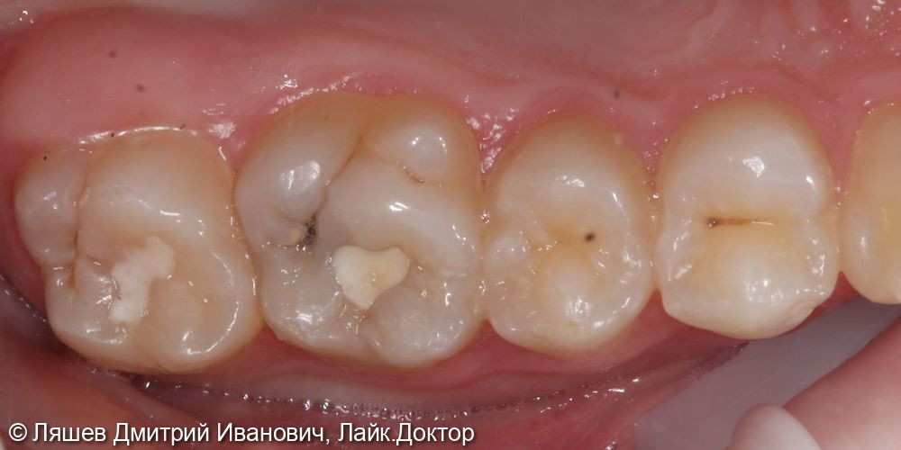 Лечение кариеса дентина зуба 2.6 - фото №1