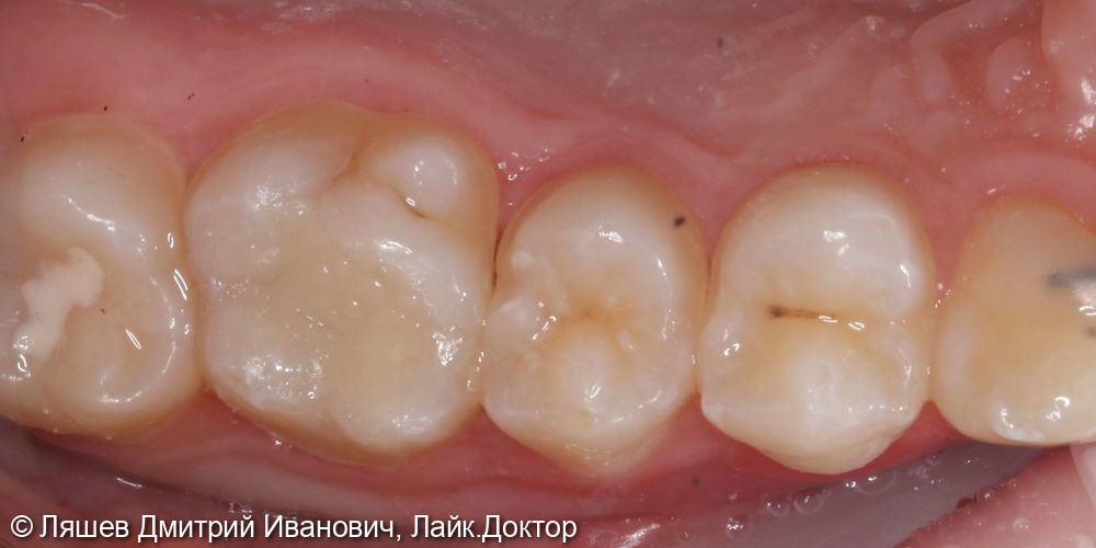 Лечение кариеса дентина зуба 2.6 - фото №2