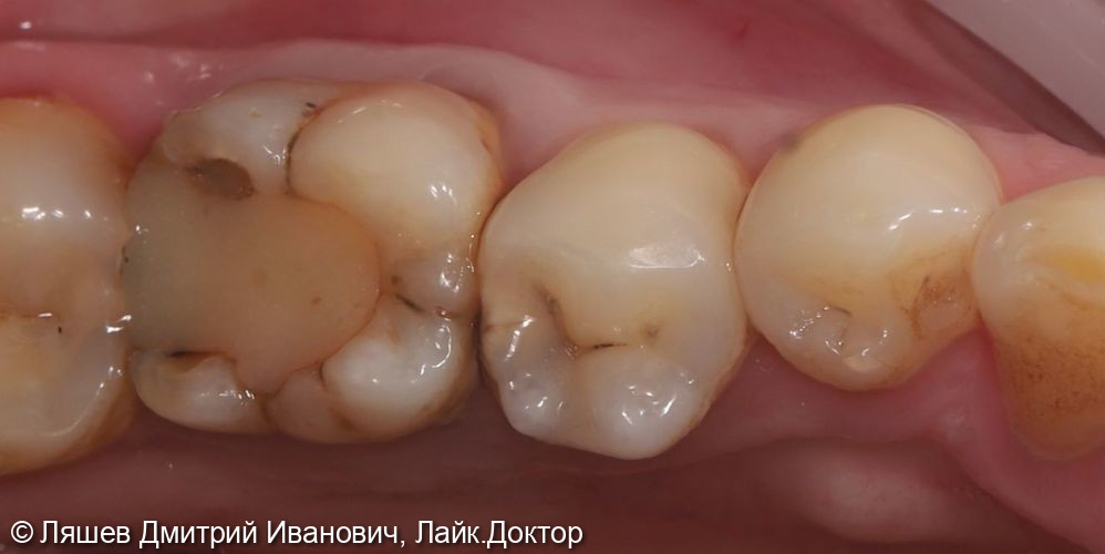 Лечение кариеса дентина зуба 3.5 - фото №1