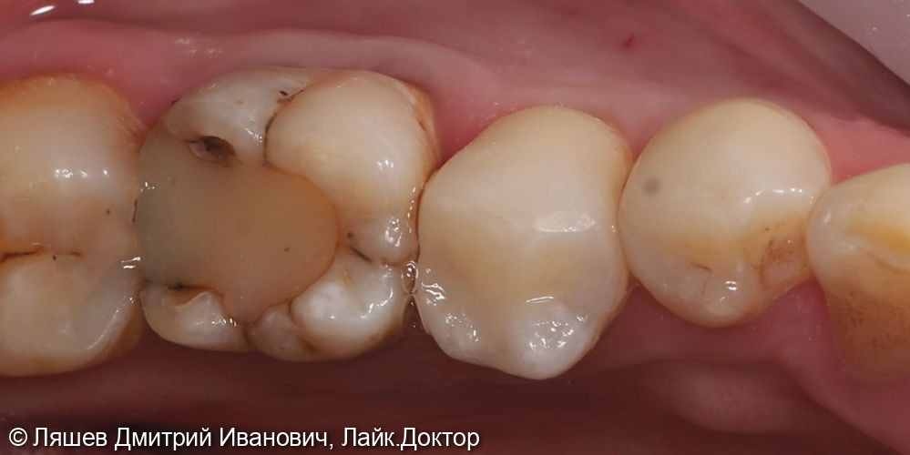 Лечение кариеса дентина зуба 3.5 - фото №2