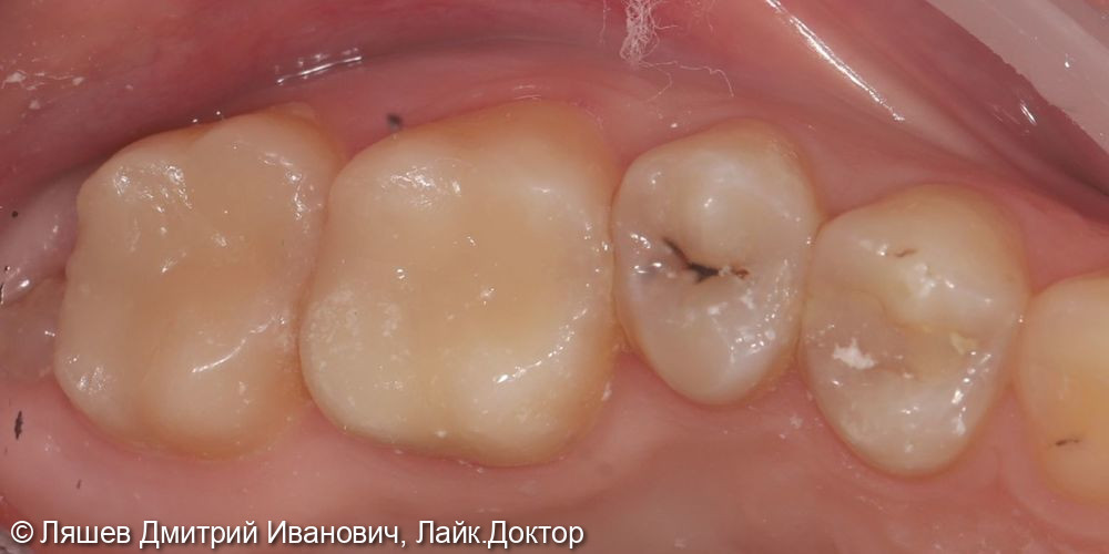 Лечение кариеса дентина зуба 2.6,2.7 - фото №2