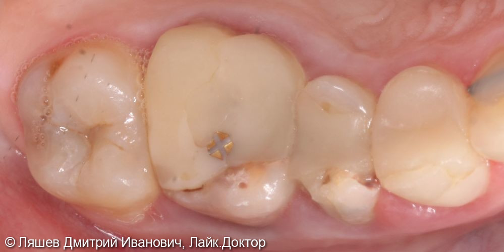 Лечение кариеса дентина зуба 2.7 - фото №1