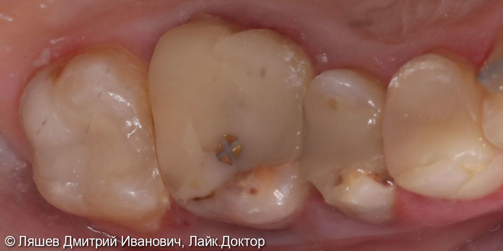 Лечение кариеса дентина зуба 2.7 - фото №2