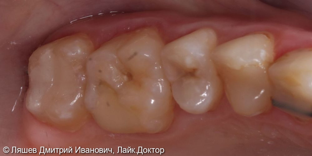 Лечение кариеса дентина зуба 1.7 - фото №2