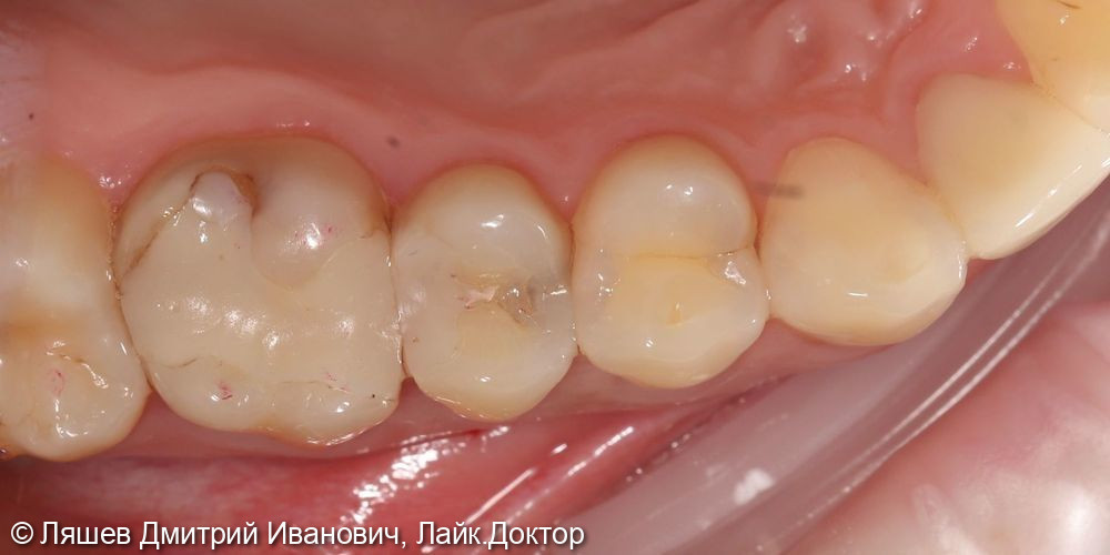 Лечение кариеса дентина зуба 1.5 - фото №1
