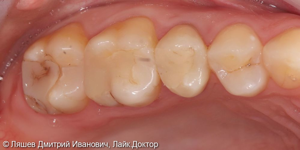 Лечение кариеса дентина зуба 1.7 - фото №1