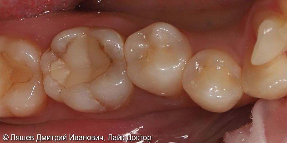 Лечение кариеса дентина зуба 4.6 - фото №1