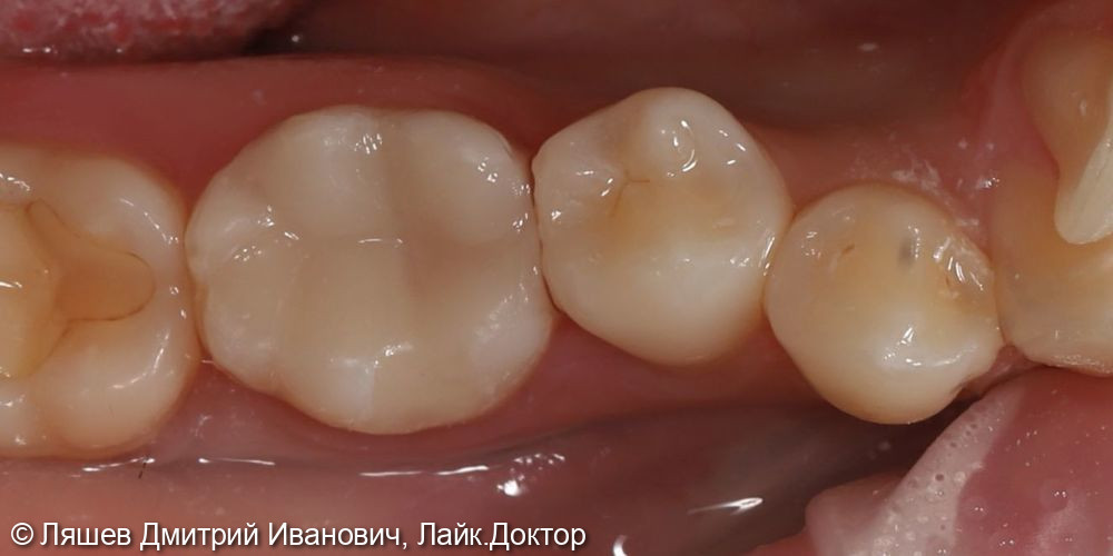 Лечение кариеса дентина зуба 4.6 - фото №2