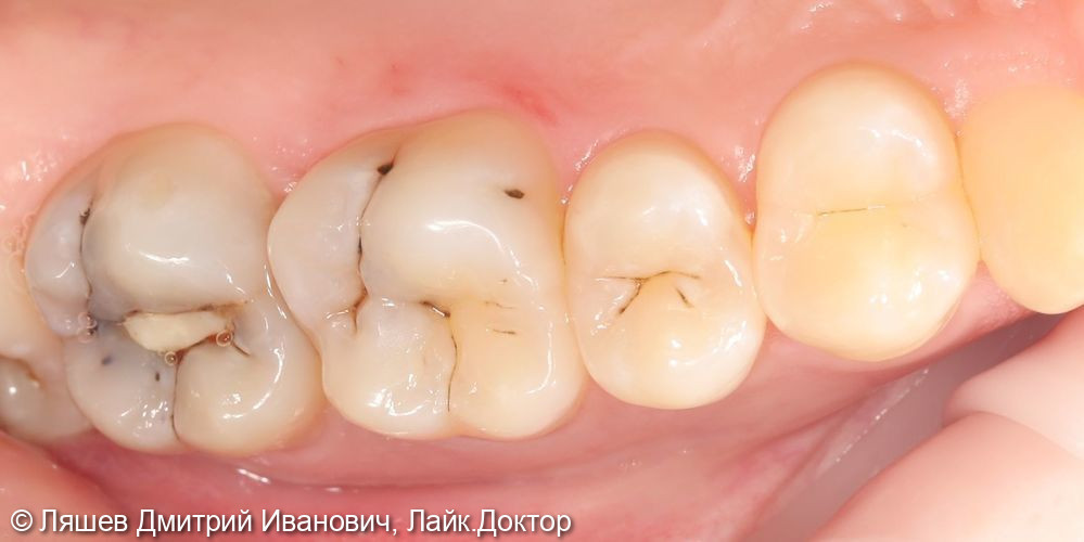 Лечение кариеса зуба 2.6, 2.7 - фото №1