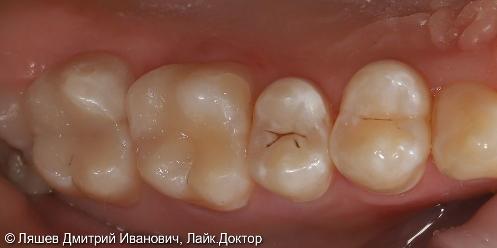 Лечение кариеса зуба 2.6, 2.7 - фото №2