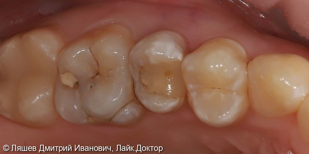 Лечение кариеса зуба 1.5,1.6 - фото №1