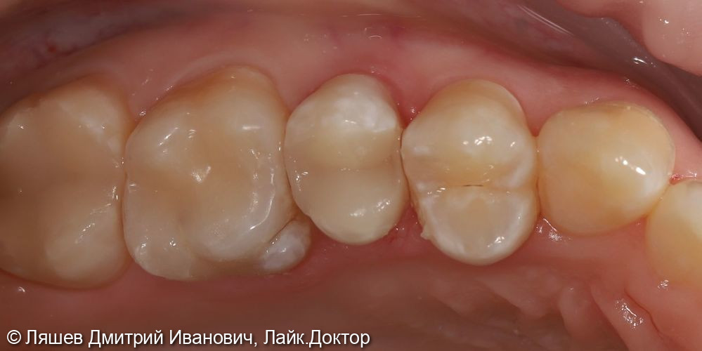 Лечение кариеса зуба 1.5,1.6 - фото №2