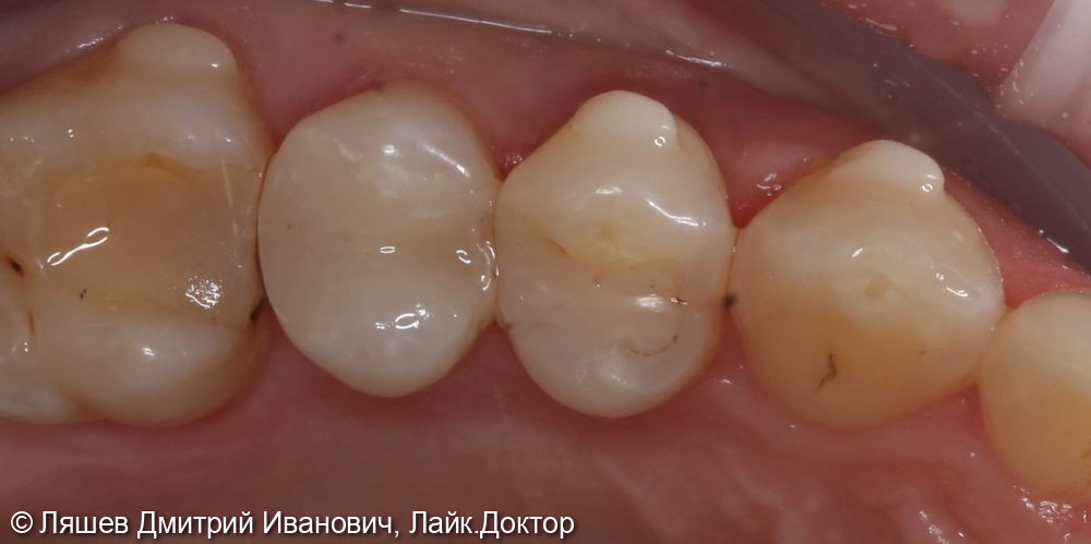 Лечение кариеса дентина зуба 1.5 - фото №2