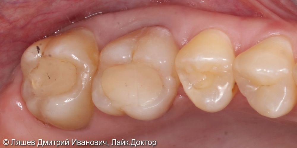 Лечение кариеса дентина зуба 1.7 - фото №1