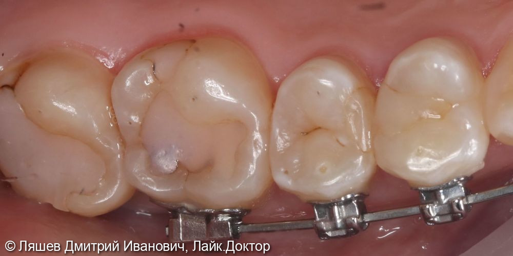 Лечение кариеса дентина зуба 2.6 - фото №1