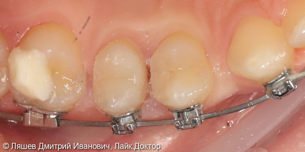 Лечение кариеса дентина зуба 2.5 - фото №2