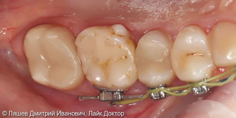 Лечение кариеса дентина зуба 2.7 - фото №2
