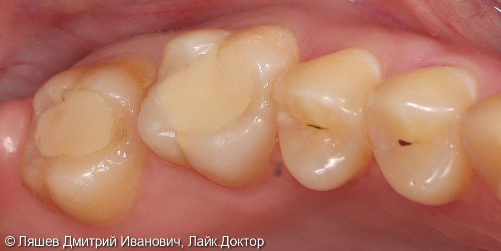 Лечение кариеса дентина зуба 1.6,1.7 - фото №1
