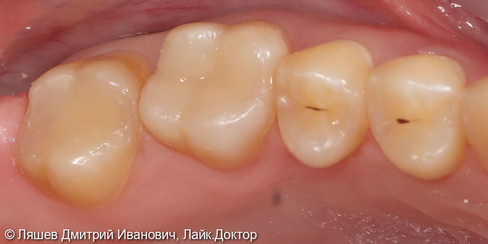 Лечение кариеса дентина зуба 1.6,1.7 - фото №2