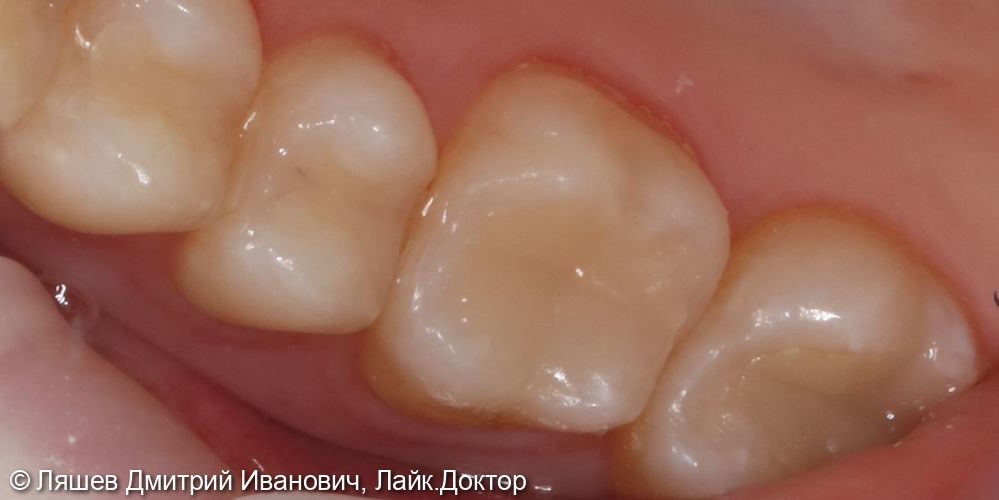 Лечение кариеса дентина зуба 1.6 - фото №2