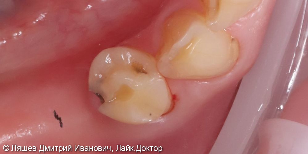 Лечение кариеса дентина зуба 4.4 - фото №1